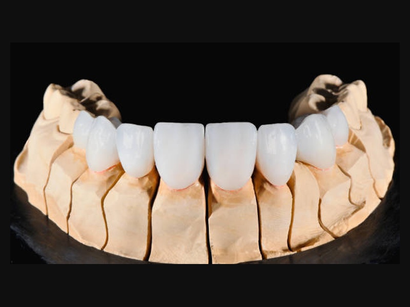 Après — Transformation sourire complet