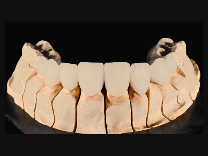 Avant — Transformation sourire complet